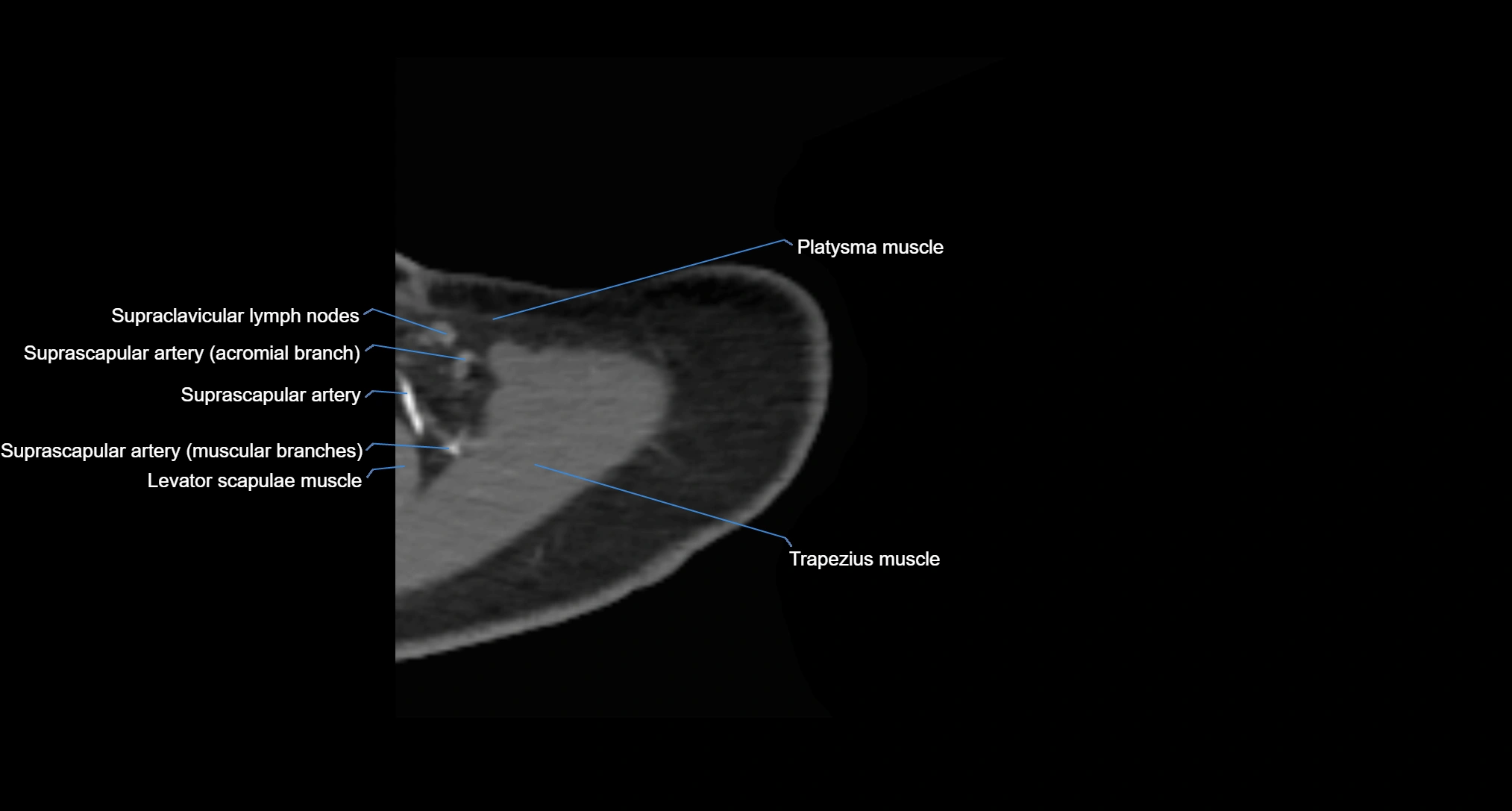 CT Shoulder axial cross sectional anatomy labelled radiology image -00007.webp